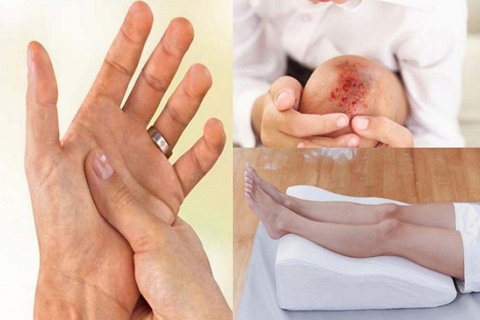 Hindari Makanan Ini Bagi Penderita Kolesterol dan Asam Urat