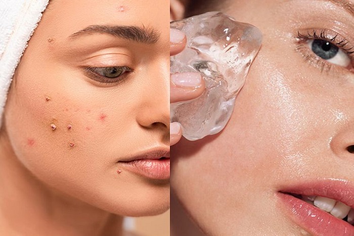 Benar Tidak Es Batu Bisa Menghilangkan Jerawat?